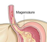 Schüssler Salze Sodbrennen